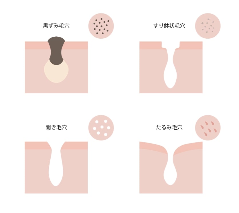毛穴ケア 毛穴のたるみ 開きができたときの対処法 コラム 基礎化粧品ドモホルンリンクル 毛穴ケア 毛穴のたるみ 開きができたときの対処法 コラム 基礎化粧品ドモホルンリンクル