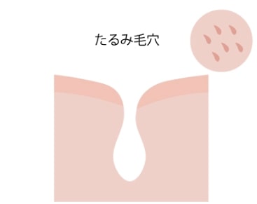 毛穴ケア 毛穴のたるみ 開きができたときの対処法 コラム 基礎化粧品ドモホルンリンクル 毛穴ケア 毛穴のたるみ 開きができたときの対処法 コラム 基礎化粧品ドモホルンリンクル
