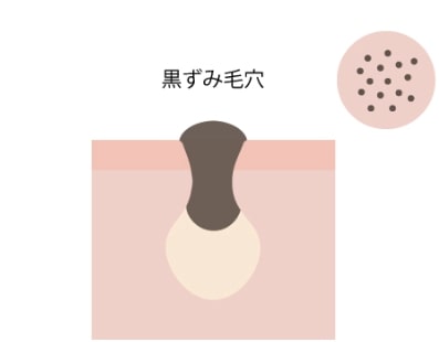 毛穴ケア 毛穴のたるみ 開きができたときの対処法 コラム 基礎化粧品ドモホルンリンクル