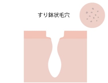 毛穴ケア 毛穴のたるみ 開きができたときの対処法 コラム 基礎化粧品ドモホルンリンクル 毛穴ケア 毛穴のたるみ 開きができたときの対処法 コラム 基礎化粧品ドモホルンリンクル