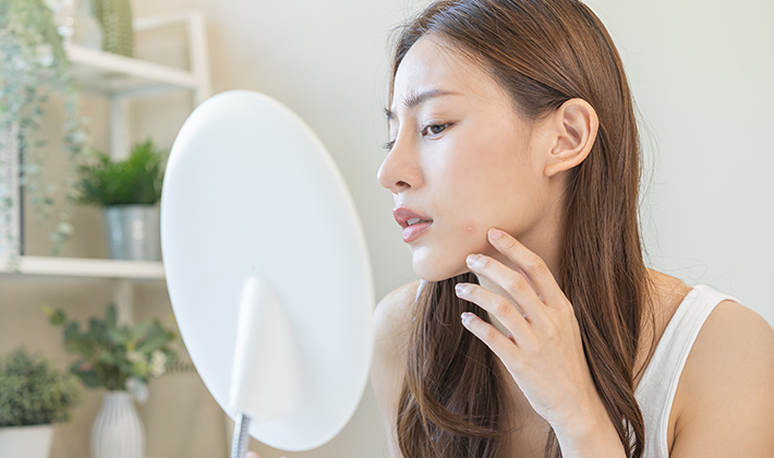 もう悩まない!あごニキビができる原因や対処法、予防する方法を解説