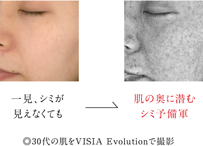 30代の肌をVISIA Evolutionで撮影