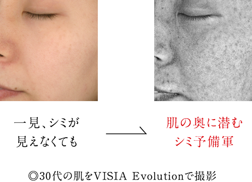 30��̔���VISIA Evolution�ŎB�e