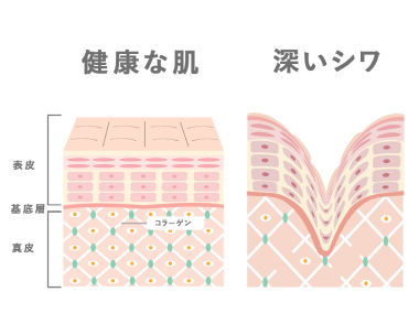 健康な肌と深いシワイメージ