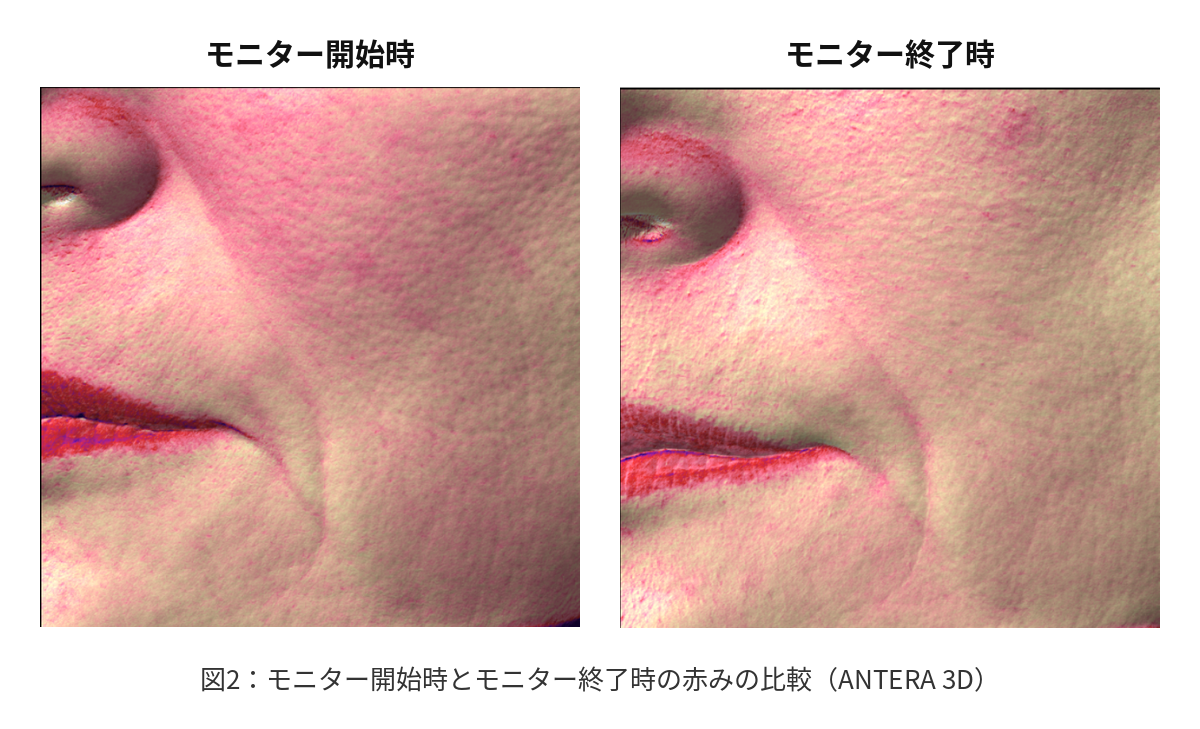 図2:モニター開始時とモニター終了時の赤みの比較(ANTERA 3D)