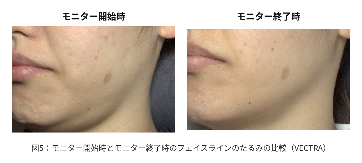 図5:モニター開始時とモニター終了時のフェイスラインのたるみの比較(VECTRA)