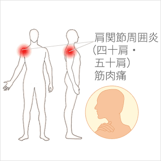 筋肉 痛い の 腕 が